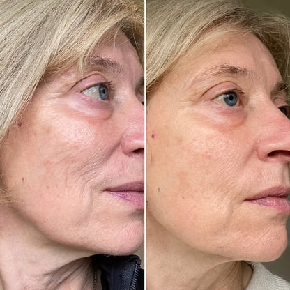 LuxeLumi Light Therapy Mask