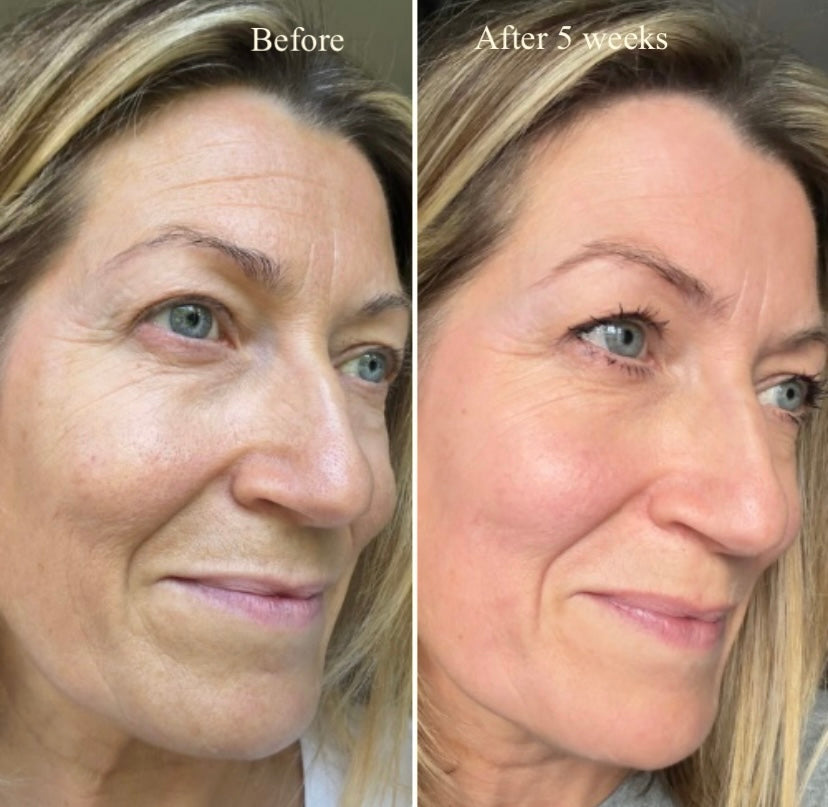 LuxeLumi Light Therapy Mask