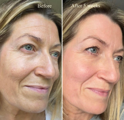 LuxeLumi Light Therapy Mask